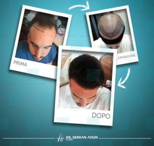 Il pre e il post trapianto della clinica Serkan Aygin.