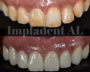 I denti di un paziente di Impladental
